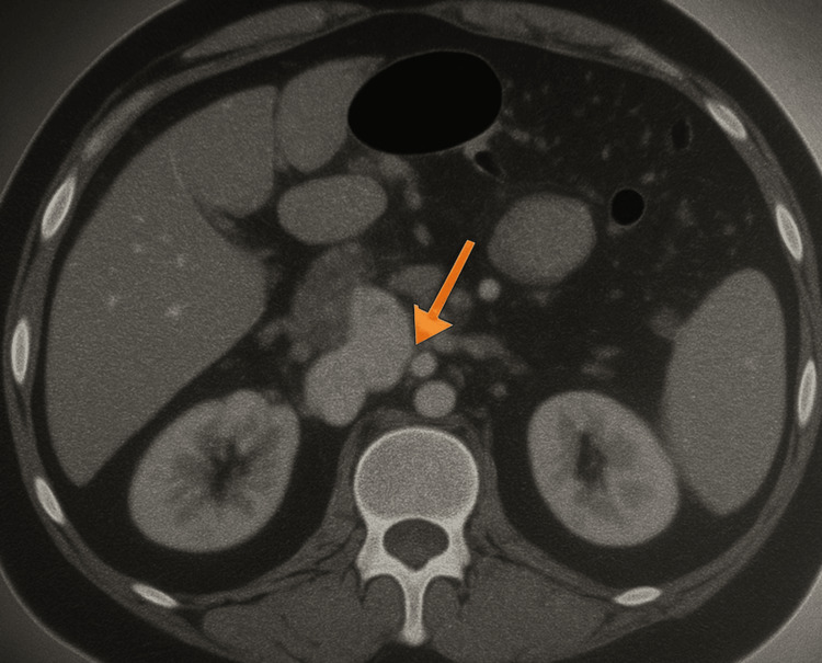 Subsequent CT abdomen showing a heterogeneous mass in the pancreas involving SMA and abutment of the aortaCT: computerized tomography; SMA: superior mesenteric arteryThe orange arrow indicates the pancreatic mass.