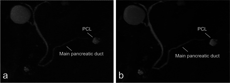 Magnetic resonance cholangiopancreatography of a male patient in his 60 s. (a) Maximum intensity projection (MIP) of the original images. (b) MIP of the images reconstructed using super-resolution deep learning reconstruction (SR-DLR). The main pancreatic duct and the contour of the pancreatic cystic lesion (PCL) are more clearly demarcated in the SR-DLR image. The depiction of the main pancreatic duct was rated by three readers as 2/2/2 for the original images and 2/4/1 for the SR-DLR images. The depiction of the PCL was rated as 4/3/4 for the original images and 4/4/4 for the SR-DLR images. Higher scores indicate better depiction
