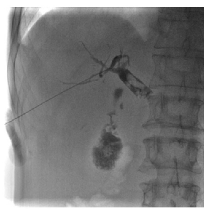 Puncture of the bile duct, and cholangiography showing the number, size, and location of simultaneous gallbladder and common bile duct stones.