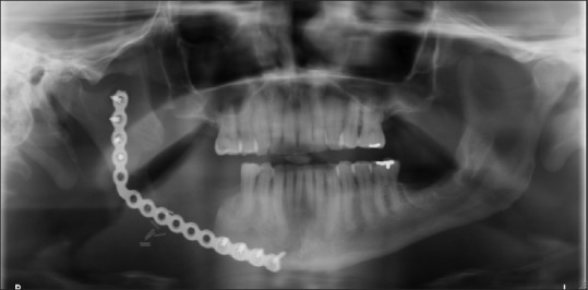 Patient B. Right mandibular resection due to chronic osteomyelitis, 2-month follow-up with hardware in place, disease free