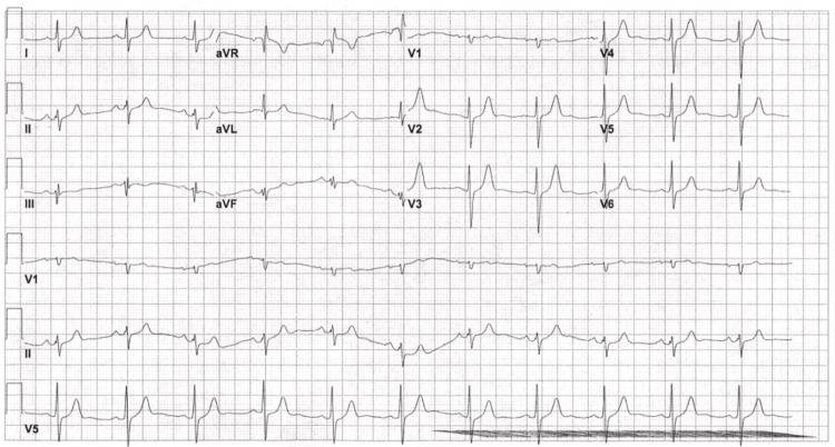 EKG done on day 3 of admission showing abnormal EKG, normal sinus rhythm, left axis deviation, and resolution of incomplete RBBB.EKG = electrocardiogram; RBBB = right bundle branch block