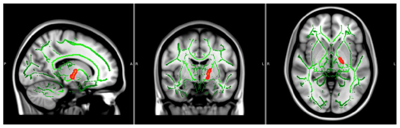 Significant OD clusters (CON < NTP, p < 0.05, corrected). Notes: Significant findings of the left internal capsule are displayed. Significant clusters bolded using FSL’s TBSS fill command. Axial and coronal views are in radiological view (left = right). P = Posterior; A = Anterior; R = Right; L = Left.