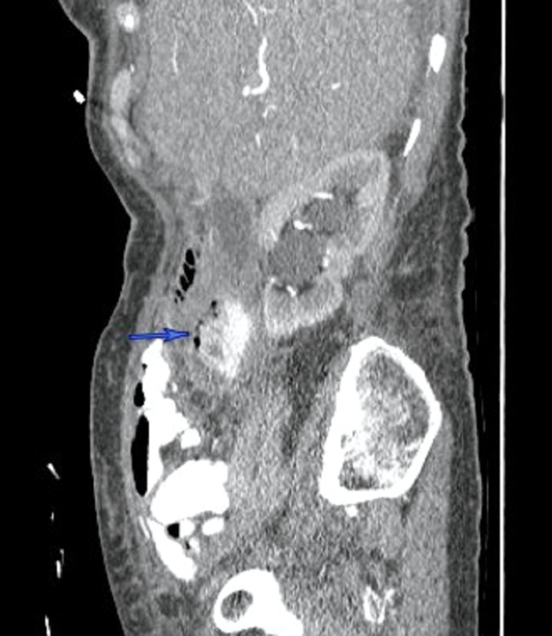 CT abdomen (sagittal section) demonstrates a complex collection with a contained contrast leak related to the perforated duodenal diverticulum