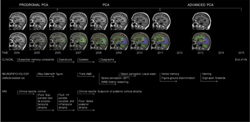 Longitudinal clinical, neuropsychological, and neuroimaging profile of an individual with pathologically proven PCA-AD showing example timelines for the provisional stages of prodromal PCA, PCA, and advanced PCA. Serial MR images (top row) show a sagittal view of the patient’s right hemisphere for all nine visits. Repeat scans were fluid-registered to the baseline image, and color-coded voxel-compression maps were produced (bottom row). The scale shows the percentage volume change per voxel (−20% to 20%) with green and blue representing contraction and yellow and red representing expansion. See Kennedy et al. [43] for a more detailed case description. Abbreviations: AD, Alzheimer’s disease; MR, magnetic resonance; PCA, posterior cortical atrophy.
