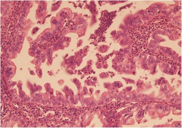 Tumor showing pleomorphism and high mitotic activity