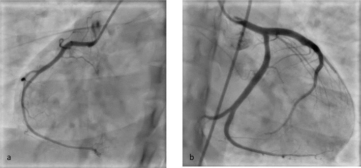 Coronary angiogram showing normal right (a) and left (b) coronary arteries
