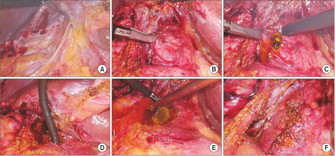 Surgical view of re-do laparoscopic common bile duct exploration. (A) Adhesions around the liver and hepatoduodenal ligaments from previous surgery. (B) Identification of the anterior surface of the common bile duct. (C) Longitudinal choledochotomy using endo scissors. (D) Choledochoscope insertion. (E) Stone extraction. (F) Closure of the choledochotomy site using 5-0 PDS II sutures (Ethicon Inc.).