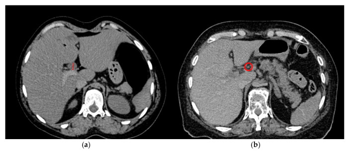 Examples of the CBD measurement in PMCT on the axial plane in a soft tissue window. (a) Significantly dilated CBD (14 mm, red dotted line) in a case of lethal opioid intoxication and (b) normal diameter (3 mm, red circle) of the CBD in a control group case.