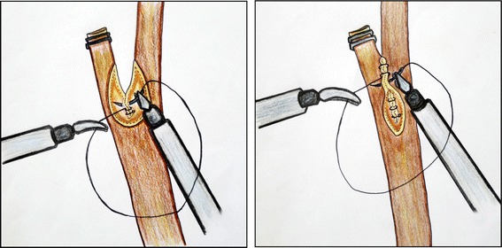 The choledochotomy was closed using the bard V-loc absorbable suture material