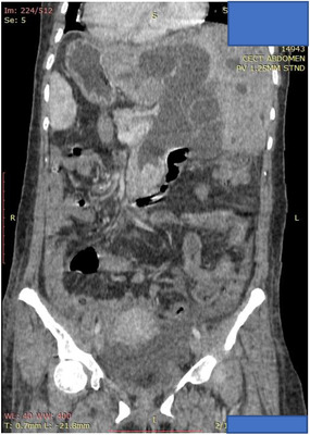 CT imaging revealed choledocholithiasis with upstream dilatation of the biliary tree