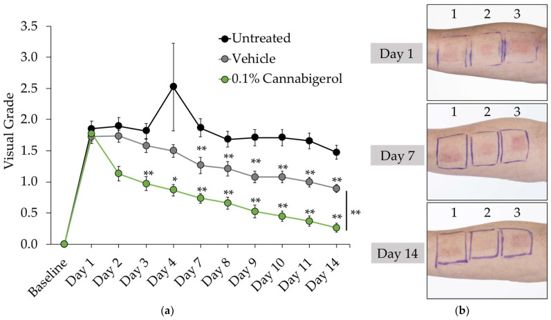 Skin irritancy was improved by 0.1% CBG in serum formulation as measured by visual grading. (a) Visual grade data represent mean ± SEM from 20 participants from each group. * p < 0.05; ** p ≤ 0.01 indicates a statistically significant difference compared to untreated group. (b) Photographs of a representative subject on day 1, 7, and 14 of the study where patch 1 = Untreated; 2 = 0.1% CBG; and 3 = Vehicle (placebo).