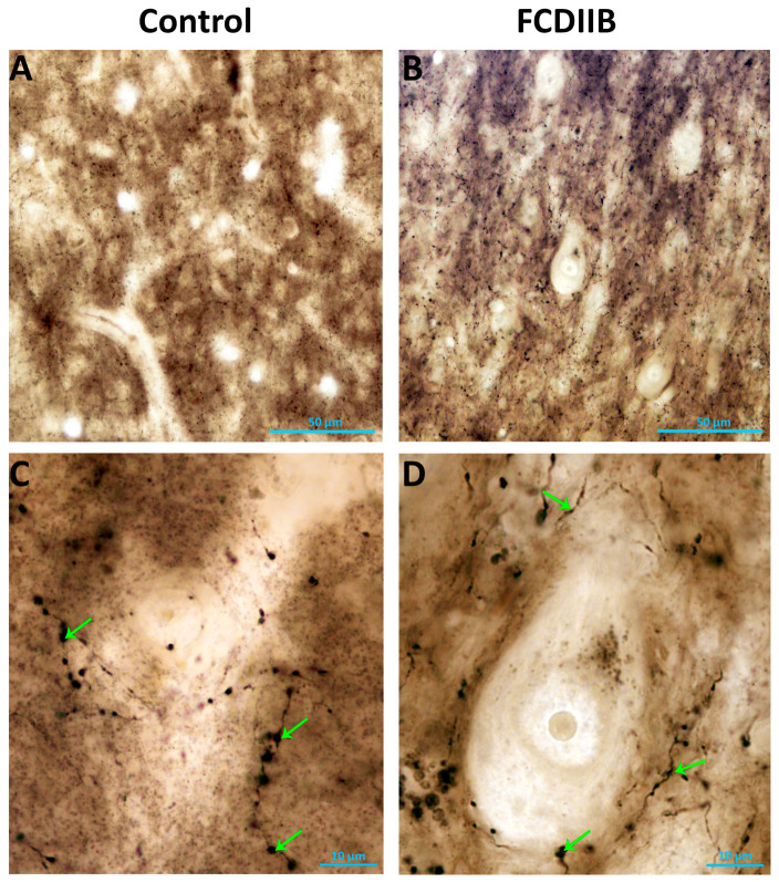 CB1R-immunopositive elements in a control sample (A,C) and in an epileptic patient with FCDIIB in frontal cortex (B,D). Green arrows show the CB1R-containing elements exhibiting a meshwork pattern surrounding the neuronal cell bodies. Scales: (A,B) 50 μm; (C,D) 10 μm.