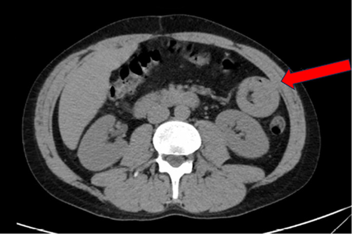 Preoperative abdominopelvic CT showing small bowel intussusception (red arrow).