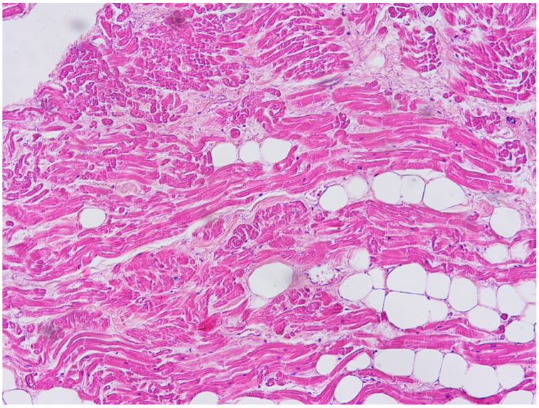 Fatty tissue inside the myocardium in the antero-lateral region of right ventricle free wall (Hematoxylin and eosin stain, 400× magnification).