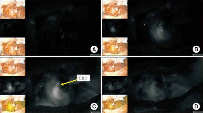 Changes in ICG fluorescence intensity over time. After administering 0.05 mg/kg of ICG, the recipient CBD (arrow) perfusion images were captured using an ICG fluorescence camera. (A) After 10 seconds. (B) After 20 seconds. (C) After 30 seconds. (D) After 40 seconds. ICG, indocyanine green; CBD, common bile duct.