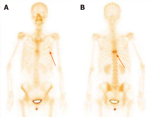 Bone scan findings. A: Metastasized tumors in the left third rib; B: Metastasized tumors in the eighth vertebral body.