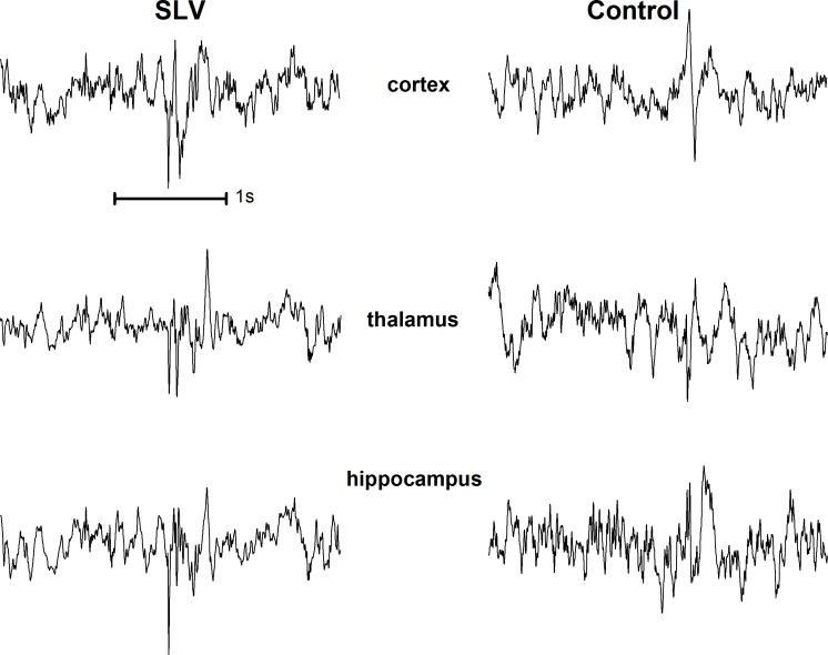 Examples of interictal spikes from a SLV326 (left) and a control animal (right).An average of 65 spikes per hour was found in 9 out of 24 SLV treated animals, versus 1 control animal out of 11 having 16 spikes per hour. Interictal spikes in the SLV group were all visible on all 3 EEG channels (left), whereas the spikes in the control animal were local, on the cortex (right).