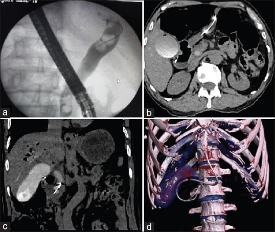 (a) Endoscopic retrograde cholangiography image depicting dormia basket with calculi in common bile duct; (b-d) Axial, coronal and volume rendered images of computed tomography scan showing broken basket with its wire in the duodenum and common bile duct