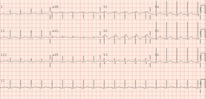 ECG on admission demonstrating characteristic Type 1 coved shaped ST segment elevation in leads V1 and V2.
