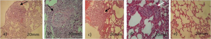 Histological appearance of lungs sections stained with hematoxylin and eosin. (Magnification of 20×, light microscopy) with metastasis (black arrows), (n = 5); (a) control (normal saline) showing large and sever metastasis with deformity, (b) CBD (5 mg/kg) like control group showing large sever metastasis and deformity, (c) DOX (5 mg/kg) showing metastasis but it is less than control and CBD groups, (d) pretreatment CBD + DOX showing intravascular metastasis (white arrow), (e) CBD + DOX showing lungs with almost normal appearance.