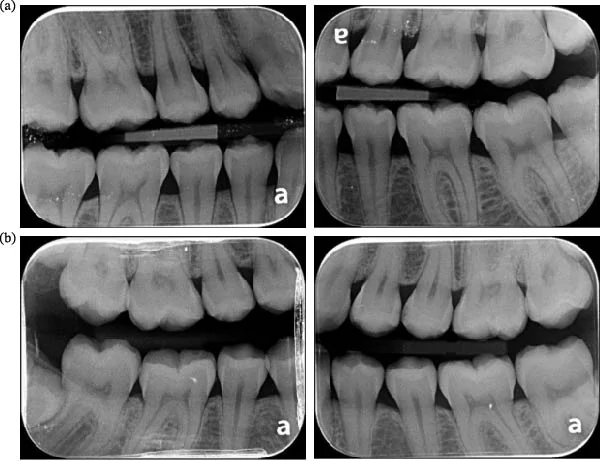 Radiographic appearance of pulp stones. Representative bitewing radiographs from study participants demonstrating radiopaque pulp calcifications (pulp stones) within the pulp chambers. (a) Bilateral first and second maxillary molars and bilateral first mandibular molars exhibiting pulp stones in a participant with documented cannabis use and clenching/grinding behaviors. (b) Bilateral first and second maxillary molars, the right shows first and second mandibular molars, and the left shows first mandibular molar exhibiting pulp stones in a participant with documented cannabis use, methylphenidate (MPH) exposure, and clenching/grinding behaviors.