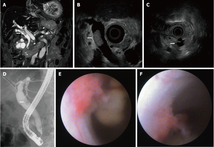 Imaging results upon referral. A: Magnetic resonance cholangiopancreatography showing a filling defect in the common bile duct (CBD); B: Endoscopic ultrasound (EUS) showing a papillary tumor in the CBD; C: EUS showing intraductal papillary mucinous neoplasm with a mural nodule; D: ERC showing a filling defect of contrast agent in the CBD; E: Peroral cholangioscopy showing a papillary tumor in the CBD; F: Tumor spontaneously detached during examination.