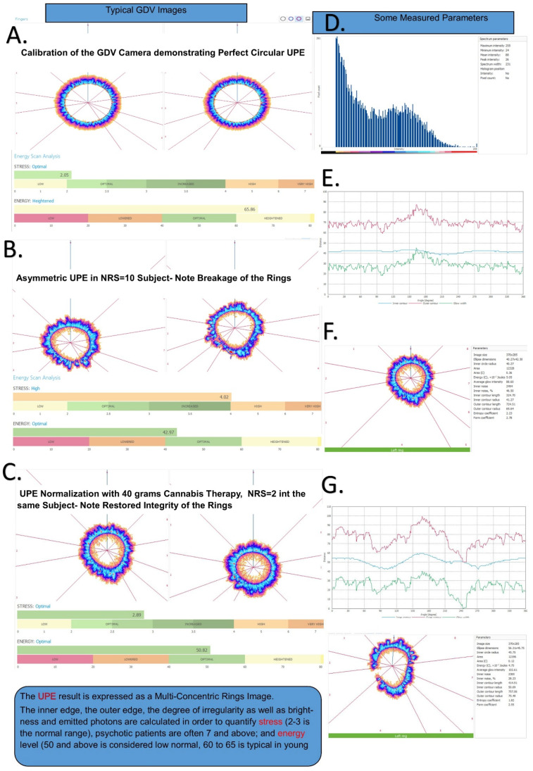 Gas discharge visualization (GDV) methodology and UPE image analysis. (A) Calibration of the GDV camera demonstrating perfect circular UPE pattern with normal stress (2.65) and energy (65.86) values. (B) Asymmetric UPE in a patient with NRS = 10, showing characteristic ring breakage associated with high pain/stress (stress: 4.42, energy: 62.97). (C) UPE normalization following 40 g cannabis therapy in the same patient, with pain reduction to NRS = 2 and restored ring integrity (stress: 2.89, energy: 56.62). (D) Histogram showing distribution of measured parameters across the cohort. (E–G) Time-series analysis of stress (red) and energy (green) parameters showing inverse relationship. The UPE result is expressed as multi-concentric rings where inner edge irregularity correlates with stress level: normal range stress 2–3, anxious/stressed patients often >4, psychotic patients often >7; energy level 50+ considered low normal, 60–65 typical in young adults.