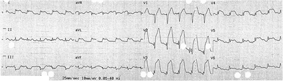 The patient’s ECG, recorded en route to the emergency department, showing ST elevation in anterolateral leads
