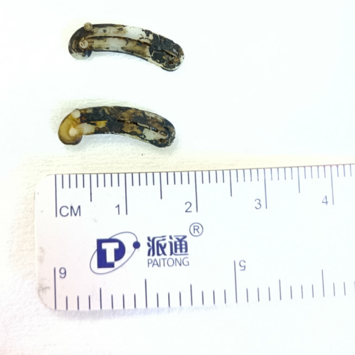 Stone fragments and two large Hem-o-lok clips were removed using a stone balloon.