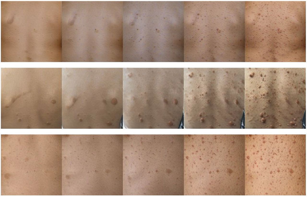 Examples of disease progression in Neurofibromatosis type 1 (NF1) generated via a generative adversarial network (GAN).13 These images show the accumulation of other features beyond café-au-lait macules (CALMs) such as cutaneous neurofibromas. Other features, such as the scapulae in some images, are also generated, since training images included features such as these.