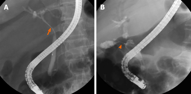 Cholangiography of patients with Mirizzi syndrome. A: Patient without a cholecystocholedochal fistula. Eccentric compression (orange arrow) of the common bile duct is observed and a short part of the cystic duct is opacified; B: Patient with a cholecystocholedochal fistula (orange arrowhead). A contrast opacified gallbladder without the typical spiral and corkscrew-like cystic duct opacification is shown.