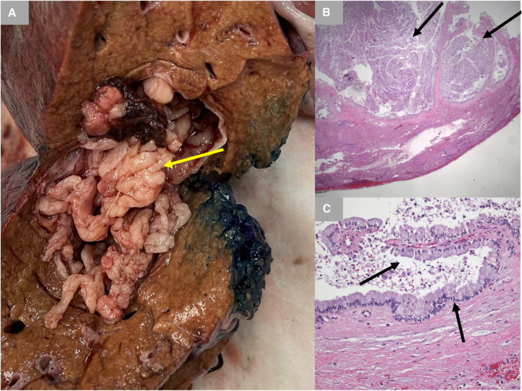 Gross pathology and histology. (A) Gross pathology with inked margins. IPMN is shown with a yellow arrow. (B) Low-power photomicrograph demonstrating papillary fronds emanating from the cyst lining (black arrows) (hematoxylin and eosin stain; 12.5× original magnification). (C) High-power photomicrograph demonstrating a very low-grade papillary mucinous epithelium (black arrow) histologically identical to that typically seen with pancreatic intraductal papillary mucinous neoplasm. There is no evidence of underlying ovarian-type stroma (hematoxylin and eosin stain; 200× original magnification). IPMN, intraductal papillary mucinous neoplasm.