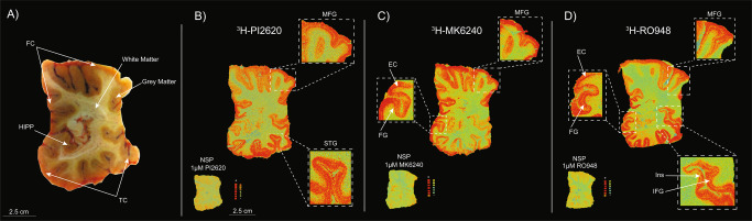 Comparative 3H-PI2620, 3H-MK6240 and 3H-RO948 autoradiography studies on large frozen adjacent brain sections from a sporadic AD patient.A Frozen hemispherical brain block dipped into carboxyl methyl cellulose gel prior to sectioning showing the cortical regions and the border between the grey and white matter. Autoradiography was performed on large frozen adjacent hemispherical brain sections from AD case A using B 3H-PI2620 (0.3 nM), C 3H-MK6240 (1 nM), and D 3H-RO948 (1 nM); 1 μM of unlabelled PI2620, MK6240 and RO948, respectively, was used to visualise the NSP binding. As the concentration used for each tracer was different, autoradiography images were not set on the same colour/brightness threshold levels for 3H-PI2620 (standards: + = 6119.9 fmol/mg, ‒ = −1.6 fmol/mg), 3H-MK6240 (standards: + = 6870.7 fmol/mg, ‒ = −4.5 fmol/mg) and 3H-RO948 (standards: + = 8233.8 fmol/mg, ‒ = −2.7 fmol/mg). 3H-MK6240 autoradiography was adapted from [21]. AD Alzheimer’s disease, EC entorhinal cortex, FC frontal cortex, FG fusiform gyrus/lateral occipitotemporal gyrus, HIPP hippocampus, IFG inferior frontal gyrus, Ins insula, MFG middle frontal gyrus, NSP non-specific binding [red (+) = highest binding; blue (‒) = lowest binding], STG superior temporal gyrus, TC temporal cortex.
