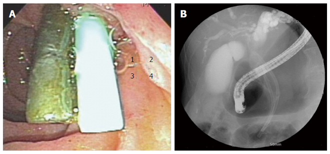 Additional stent inserted alongside previous stent (A) and large stones formed around the plastic biliary stent (B).