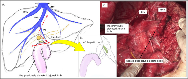 Surgical schema and intraoperative findings during hepatectomyA: Author’s original surgical schema illustrating transection of the elevated jejunal limb just below the hepaticojejunostomy created during the initial surgery (red double-headed arrow). The planned hepatic transection line is indicated by the red dashed arrow.B: Schematic illustration showing reuse of the preserved Roux-en-Y limb for reconstruction via left hepatic duct–jejunal anastomosis.C: Intraoperative photograph demonstrating an extended right hepatectomy with en bloc resection of the previous hepaticojejunostomy. The preserved Roux limb was subsequently reused to construct a left hepatic duct–jejunal anastomosis.MHV: Middle hepatic vein; LHV: Left hepatic vein; RHV: Right hepatic vein