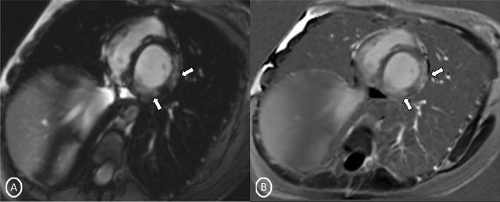 Short-axis 2-chamber PSIR sequence (basal cavity) A MAG; B PHASE images—showing patchy delayed gadolinium enhancement of intramural, subepicardial, tans-mural enhancement in inferior and lateral wall segments of cardiac basal cavity