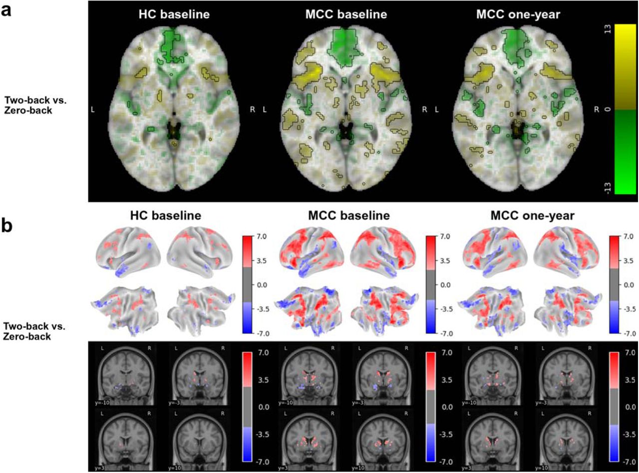 Brain activation for the N-back task’s two-back vs. zero-back contrast across groups and timepointsThe HC group at baseline (n=22), the MCC group at baseline (n=40), and the MCC group at one-year (n=40) did not show activation differences between the two groups at baseline or between the two time points of the MCC group. Cannabis use frequency changes were not associated with brain activation at one-year. Figure 1a: Voxel-wise average brain activation, colored by effect size and opacity-scaled by z-scores with significance threshold (FDR=0.05) outlined, for the two-back vs. zero-back contrast of the N-back task. z-thresholds: HC group at baseline=3.05; MCC group at baseline=2.47, and MCC at one-year=2.60. Colorbar displays effect size. Figure 1b: Grayordinate-wise average brain activation z-scores above significance threshold (FDR=0.05) for the two-back vs. zero-back contrast of the N-back task. z-thresholds: HC group at baseline=2.60), MCC group at baseline=2.21, and MCC at one-year=2.35. Colorbar displays z-scores. HC=healthy control; MCC=medical cannabis card.