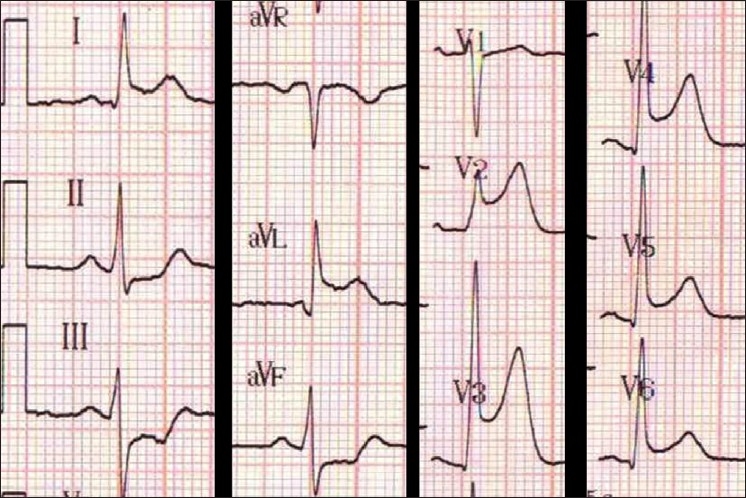 Initial electrocardiogram of Case 1, which shows anterior ST elevation (V2-V4) with reciprocal changes in the inferior leads
