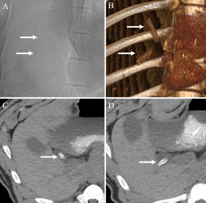 Two-month follow-up CT scan images showing stent fracture. (A) Scout image and (B) 3D-volume rendered image shows complete fracture of the stent (arrows). (C,D) Axial images also shows two fragments of fractured stent (arrows) within the common bile duct without any complications such as biliary obstruction or bile leakage.