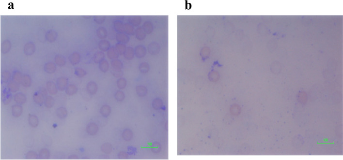 a Blood film of cells exposed to 1:1, THC:CBD extract. Blood film showing red cell changes in 1:1 THC:CBD extract—marked red cell agglutination with red cell degeneration. Scale = 100 μm. b Blood film of cells exposed to 4:1, THC:CBD extract. Blood film showing red cell changes in 4:1 THC:CBD extract—marked red cell degeneration; hardly any intact RBCs on film. Scale = 100 μm