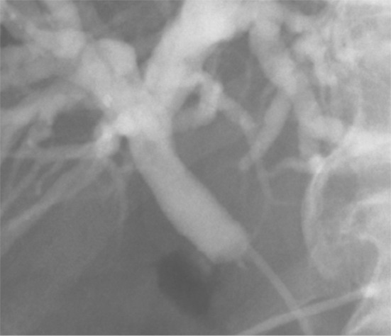 Preoperative endoscopic cholangiogram. Endoscopic retrograde cholangiopancreaticography confirms the 1 cm-lengthened segmental stricture at the proximal common bile duct with marked dilatation of the central bile duct.