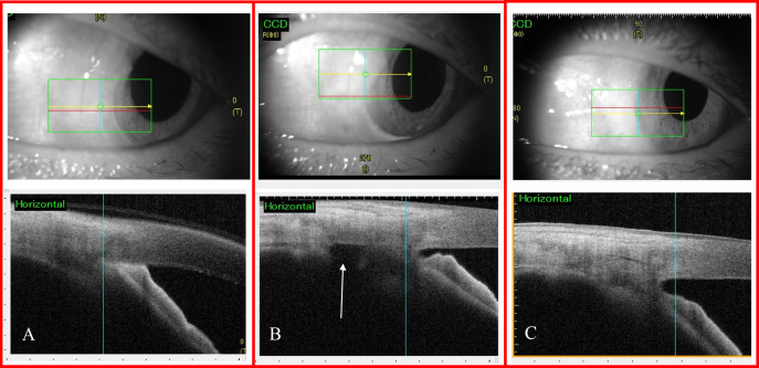 Evaluation of angle closure and ciliary body defect using anterior segment optical coherence tomography (AS-OCT) before and after intervention. (A) Preoperative angle closure with nasal irido-cornea contact. (B) Postoperative day 1 following low-dose transscleral cyclophotocoagulation demonstrating angle opening as well as a ciliary body defect (white arrow). (C) Postoperative 1 month following phacoemulsification showing persistent open angle and resolution of the ciliary body defect. The red line in each infrared image localises the corresponding AS-OCT scan below.