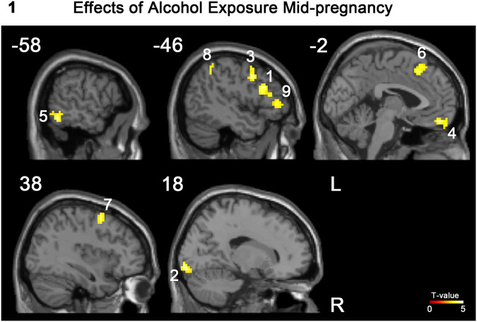 Prenatal exposure to alcohol and its impact on reward processing in young adulthood.Sagittal views of the 9 clusters showing significantly greater brain responses to reward in young adults prenatally exposed (vs. non-exposed) to alcohol.