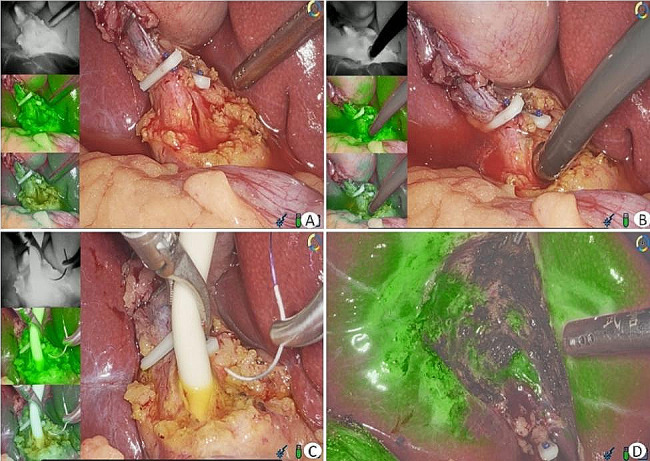 LCBDE under fluorescent navigation. A The CBD was incisioned; B Cholangioscopy was performed to explore and remove stones; C A T-tube was placed and sutured for fixation; D The gallbladder bed wound was examined to avoid bile leakage