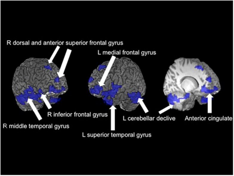 Significant fMRI clusters predicted by the interaction between gender and binge-drinking status (N = 95). Areas in blue indicate where female binge drinkers demonstrated significantly reduced BOLD response during the spatial working memory task compared to female controls, while male binge drinkers demonstrated increased BOLD response (adapted fromSqueglia et al., 2011).