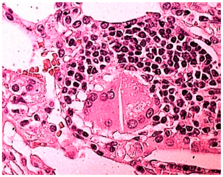 Magnification of 250×, hematoxilin–eosin staining (HE): elongated needle-like inclusions crossing almost the entire body of a multinucleated cell. The evaluation under a polarized light microscope highlighted the birefringence of the needle-like inclusions and crystals with a morphology of organic fibers, such as cellulose, thus suggesting the diagnosis of pulmonary fibrosis and granulomatosis from cellulose-cut cocaine.