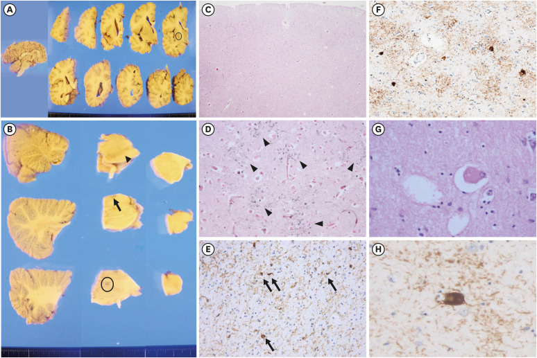 Macroscopic (A and B) and microscopic (C-H) findings of the brain. (A) Sagittal section presenting the frontal lobe and midbrain atrophy (left). The midbrain is significantly atrophied than the pons. Coronal sections of the brain exhibiting mild cortical atrophy in the frontal cortex and thalamic region and moderately dilated ventricles with lacunar infarct in the putamen (circle) (right). (B) The midbrain exhibited moderate-to-severe hypopigmentation in the substantia nigra (arrowhead) and mild pallor in the locus ceruleus (arrow) with microhemorrhage in the pons (circle). (C) Mild superficial microvacuolation was observed in the frontal cortex (H&E, 40×). (D) Gallyas silver staining revealed dense astrocytic plaques (arrow heads) in the frontal lobe (200×). (E) Tau-positive threads and coiled bodies (arrows) were frequently observed in the subcortical white matter of the frontal lobe (AT8, 400×). (F) Several tau-positive neurons and threads were identified in the amygdala (AT8, 200×). (G) A ballooned neuron is observed in the amygdala (H&E, 400×). (H) A ballooned neuron is highlighted by tau staining in the amygdala (AT8, 400×).H&E = hematoxylin and eosin staining.