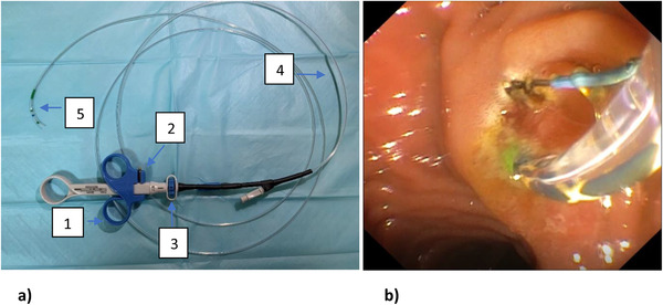(a) Leo Med triple lumen sphincterotome. (b) Endoscopic sphincterotomy using the rotatable sphincterotome