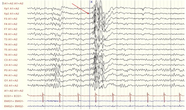 Last electroencephalogram (performed on the patient at 12 years and 4 months of age) showing a diffuse paroxysm of epileptiform abnormalities (red arrow), characterized by polyspikes and spike-wave complexes with low recurrence, present during wakefulness and sleep, without clinical correlation.