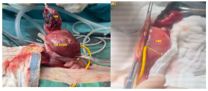 Cholecystectomy (A) of the gallbladder (GB), cystic duct (CD), and part of the dilated common bile duct (CBD) with a two-layer suture closure (B) of the CBD after cholecystectomy, and choledochostomy tube (T) in the dilated CBD.
